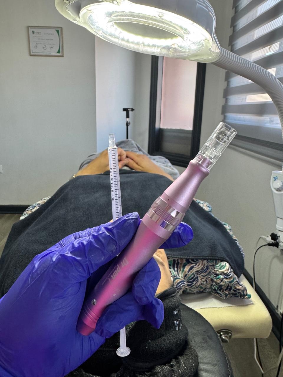 Limpieza facial profunda con microneedling